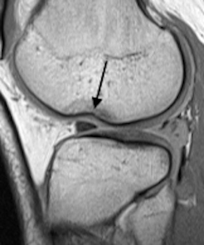 Left: Bucket-handle tear of the medial meniscus in a 16-year-old girl. Coronal proton-density image demonstrates irregular, torn, medial meniscal body that is smaller than normal (white arrow), and the flipped portion of the medial meniscus that appears as an unexpected low signal structure below the posterior cruciate ligament in the intercondylar region. Right: Femoral condyle impaction fracture in a 15-year-old girl. Sagittal proton-density image shows cortical depression (arrow) with surrounding edema. Note the associated complex tear of the posterior horn of the lateral meniscus.