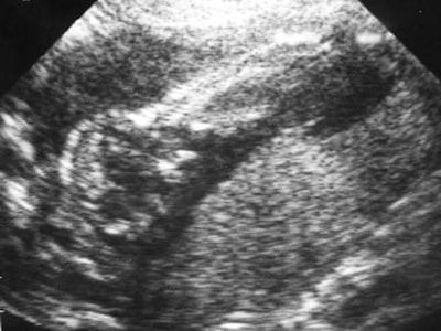 Ultrasound has changed the perception of the fetus. Images like this one taken in 1985 have a powerful social meaning, and for many people are the first cherished pictures of a child.
