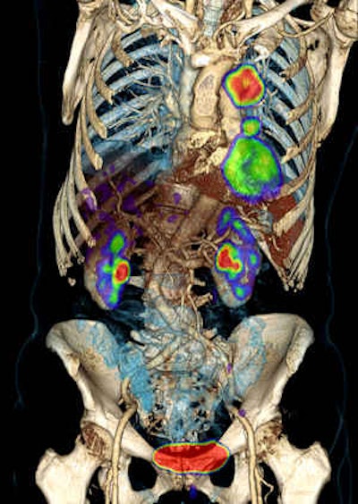 PET/CT can produce stunning images like this one, which was taken on a Biograph mCT system, but the technique raises important training and turf issues that are addressed in the new RCR document. Image courtesy of Siemens Healthcare.