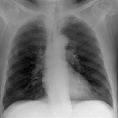 Simulated chest radiograph