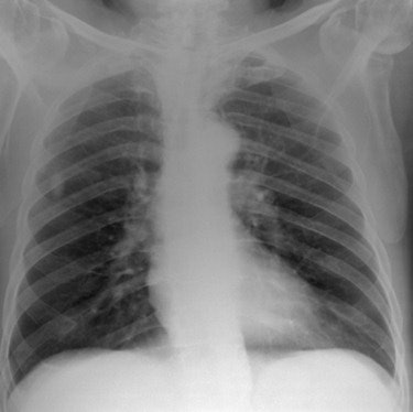 Above and below, simulated chest radiographs of an average sized patient reconstructed at tube voltages of 50 kVp (above), and 125 kVp (below). Images courtesy of Craig Moore, PhD.