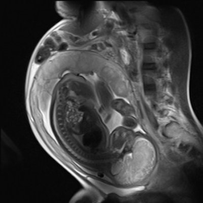 Imaging can provide exquisite details of the fetus. This sagittal half-Fourier acquisition single-shot turbo spin-echo (HASTE) MR image was used for planning further fetal images in other planes, and was taken at the Clinical Research Imaging Center, University of Edinburgh, U.K. Image courtesy of Janet De Wilde, PhD, and Dr. Scott Semple.
