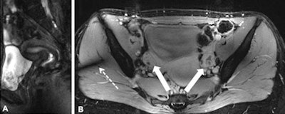 T2 turbo spin-echo imaging (A) of the female pelvis revealing good quality delineation of the zonal anatomy of the uterus. 2D FLASH post-contrast imaging (B) shows lack of enhancement of the ovarian cysts (arrows). The thin arrow in figure B marks a residual inhomogeneity artifact in the right gluteal muscle. All images courtesy of Dr. Lale Umutlu.