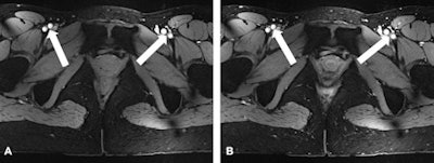Nonenhanced (A) versus post-contrast (B) 2D FLASH imaging of the pelvis. Notice the equivalently high-quality delineation of the arterial and venous vasculature (arrows).