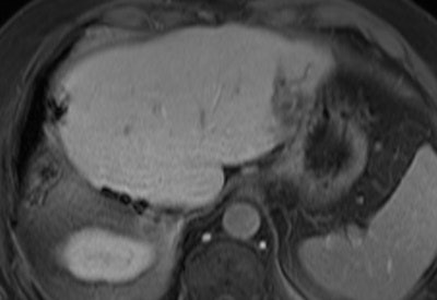 Above: MRI of an active liver metastasis near the gastric wall (parts of the liver had already been surgically removed two years previously). Below: Three IRE probes surround the tumor. Bottom: Signs of a tissue-sparing destruction of the liver metastasis in the CT review after the procedure.Images courtesy of Dr. Christian Stroszczynski, Regensburg University Hospital.