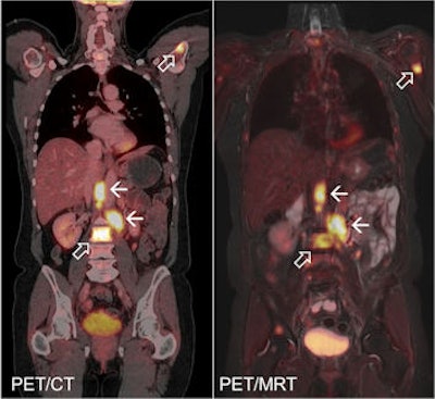 PET/CT (left) and PET/MR (right) images of patient with metastasising carcinoma of the ovaries. Image courtesy of Dr. Karsten Beiderwellen, Essen University Hospital.