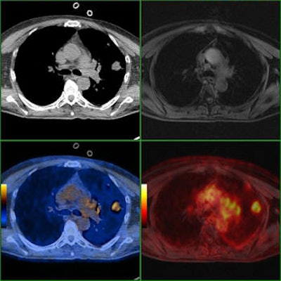 Comparison of PET/CT and PET/MRI of a patient with a solitary lung metastasis showing superiority of CT versus MRI. Axial CT and axial PET/CT images show the large metastasis in the left lung. The lesion is only detectable in co-registered PET/MRI images but undetectable on the MRI.
