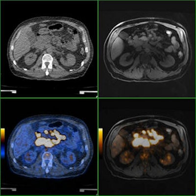 Comparison of PET/CT and PET/MRI of a patient with diffuse large B-cell lymphoma. Axial CT and MRI images show bulky disease in the mesenterium with corresponding 18F-FDG activity in axial PET/CT and PET/MRI. In this patient, lesion conspicuity was rated as 'excellently delimitable' for MRI and 'good delimitable' for CT. All images courtesy of Dr. Philippe Appenzeller.