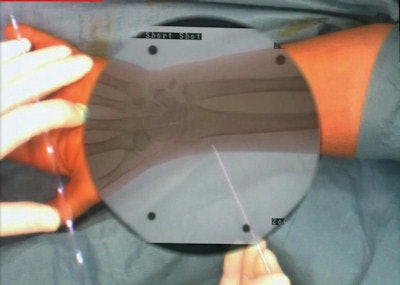 This image demonstrates the use of CamC system during a Kapandji procedure. The augmented reality view provided by the coregistered x-ray and optical imaging systems within CamC allows the surgeon to take one x-ray shot and execute the procedure under the guidance of the augmented reality view and in this way reduce the x-ray radiation dose in particular to the patient but also to the surgical crew.