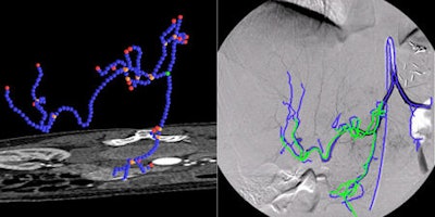 Complex catheter navigation for angiographic procedures can be supported by systems allowing the integration of preinterventional 3D image data into the intervention room. Via coregistration of pre- and intrainterventional images, physicians obtain more detailed information about current catheter positions and are able to follow predefined pathways through the vasculature. The first image (left) visualizes the 3D segmentation of vasculatures in CT angiography images used for planning a vascular intervention. The second image (right) visualizes the registration of the 3D segmented image used for diagnosis and planning and the 2D angiography, which is used for guidance during interventional procedures. All images courtesy of Dr. Nassir Navab.