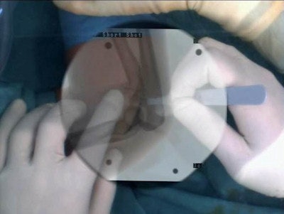 CamC enhances the conventional x-ray image with a coregistered video image. Physicians are able to switch between different views allowing optimal onsite planning and relocation of incision points.