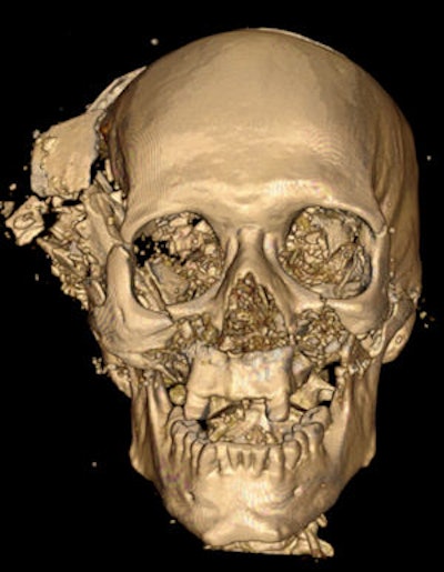 volume-rendered 3D CT reconstruction