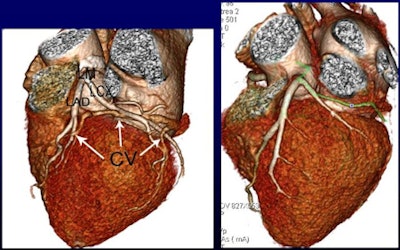More contrast volume in the whole-heart CT image from group A (0.8 mL), left, resulted in better enhancement of the coronary sinus and veins compared to group C (0.6 mL) at right. The group C image is still diagnostic, however. All images courtesy of Ding Zhong-Xiang.
