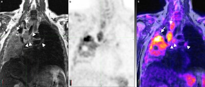 Coronal T2 turbo spin-echo sequence (a) of the chest and corresponding PET and PET/MR fusion (b, c) demonstrates a non-small cell lung cancer tumor occupying a large portion of the right lung with multiple enlarged lymph nodes (arrowheads). The superior soft-tissue contrast resolution of MRI allows for the identification of each separate lymph node and confident distinction of lymph nodes from vascular structures (dotted arrow). Similarly, atelectasis can be distinguished from tumor (arrow) even in the absence of intravenous contrast. All images courtesy of Dr. Andres Kohan.