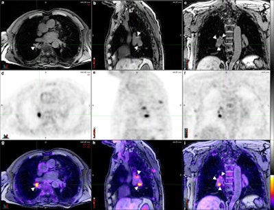 Axial (a), sagittal (b), and coronal (c) T1 fat-saturated MR images reconstructed from a volumetric 3D T1-weighted gradient-echo dataset, corresponding PET (d, e, f) and PET/MR fusion images (g, h, i). Pathologically increased tracer uptake discloses the neoplastic nature of the visualized lymph nodes. There is excellent soft-tissue contrast in MRI, which allows for the clear delineation of lymph nodes (arrowheads) and their distinction from vascular structures despite the absence of intravenous contrast.