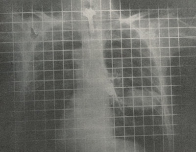 An early bronchogram using the stationary crisscross Bucky grid with grid lines visible.