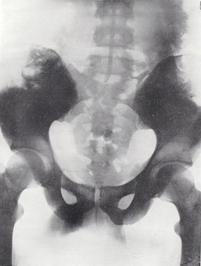 Normal pelvis from 1921 using the Potter-Bucky diaphragm and a Coolidge tube.