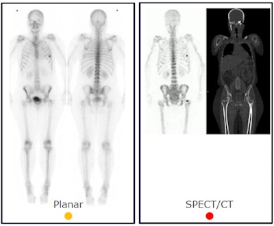 In this 51-year-old woman with breast cancer, planar scintigraphy shows focal uptake on the rib on the left (ruled an equivocal scan). SPECT/CT shows the same focal uptake in the hip region, which was diagnosed as bone metastases. PET/CT and PET/MRI showed the two lesions but also detected an additional lesion in the midthoracic spine. Images courtesy of Dr. Johan Löfgren.
