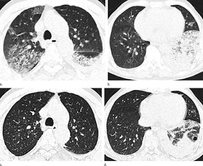 Axial thin-section CT images in 65-year-old man with H7N9 influenza. Top row, initial images obtained at admission show extensive GGOs and consolĀidation. Bottom row, images at seven-day follow-up show complete resorption of the lesion in the right upper lobe and partial resorption in the left lower lobe with a round cystic change. Images republished with permission of RSNA from Radiology July 2, 2013.