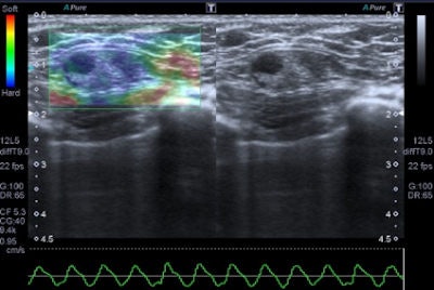 elastography