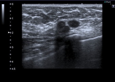 A 45-year-old woman with a palpable mass in the lower-outer quadrant 2 cm away from the nipple. There was no erythema, ecchymosis, skin ulceration, or dimpling and no axillary lymphadenopathy was detected. Baseline ultrasound shows an isoechoic lump with regular margins, with some cystic areas within. At elastography the nodule presents a color map score 4 according to the Ueno-Itoh classification, with absence of elasticity, depicted as a completely blue area with a different peripheral glow. Placing two different regions of interest (in normal breast tissue and within the nodule), strain ratio obtained is 8.96. Gross pathology confirmed a cystic cancer.