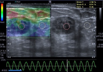 Elastography