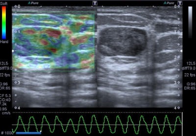 Elastography