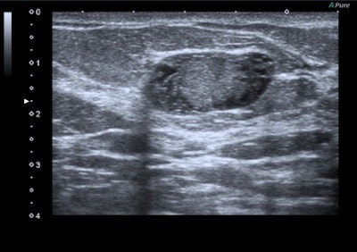 A 47-year-old woman with a small breast lump. Baseline ultrasound shows a hypoisoechoic nodule with regular and well-defined margins. Elastography demonstrates a pattern 2 according to the Ueno-Itoh classification with prevalent elasticity, as a predominance of green, with few, if any, blue and red spots inside. Strain ratio, measured by placing two different regions of interest (placed in normal breast tissue and within the nodule), was 0.36. Gross pathology confirmed a benign fibroadenoma. All images courtesy of Dr. Paolo Ricci.