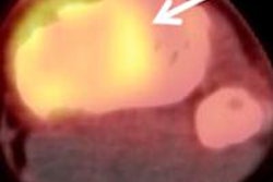 2013 07 10 14 53 40 631 Jnm Pet Ct Mri Osteosarcoma Byun 450 20130710215753