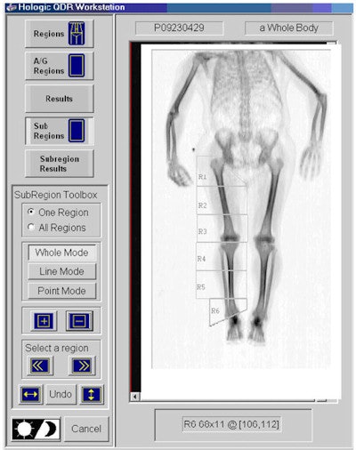 The six manually defined subregions (R1 to R6) within the lower right leg used to acquire subregional bone mineral density.