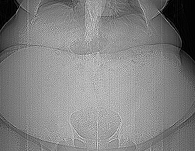Digital radiograph of a 635-lb patient after a motor vehicle accident. To image this patient with CT, knowing the weight limits of the available CT scanner is critical -- most CT scanners have a weight limit of 450 lbs to 500 lbs. CT scanners available with higher weight limits include: Toshiba Medical Systems (660 lb, Aquilon One); Philips Healthcare (650 lb: Brilliance Big Bore); GE Healthcare (650 lb: Lightspeed Xtra), and Siemens Healthcare (660 lb: Somatom Definition).