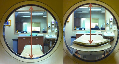 Though CT aperture diameters may be accurate in the horizontal plane, they do not account for the table thickness entering the gantry bore. The vertical diameter is actually 20 cm less than the published diameters, limiting its use in morbidly obese patients. All images courtesy of Dr. Rajeev Suri, an associate professor of vascular and interventional radiology at the University of Texas Health Science Center in San Antonio, U.S.