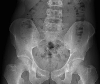 Residual cocaine-filled packet found in the cecum of a 33-year-old body packer. Abominal x-ray of the lower abdomen (above) shows no clear abnormality, whereas sagittal CT reformatted image (below) clearly depicts a dense packet (arrow), located in the cecum. Note that even in retrospect, the packet is still not visible on AXR. All images courtesy of Dr. Pascal Rousset.