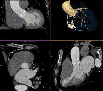 Transaortic valve implantation planning with dual-source CT as seen on graphic user interface. Images courtesy of Dr. Hans-Christoph Becker.