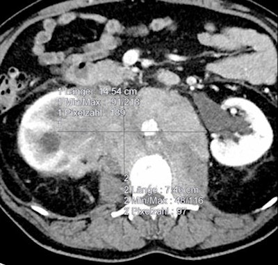 As shown in these cases, volumetry is more sensitive than RECIST measurements for determining therapy treatment response. All images courtesy of Dr. Anno Graser.
