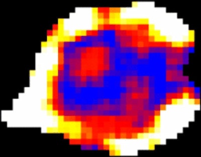 Glucose uptake varies within tumors, as demonstrated using a new technique developed by scientists at UCL. 'Hot' regions at the edge of the tumor show increased uptake compared with 'cold' central regions, which could be used in the future to determine the best therapies to give to individual patients. Image courtesy of UCL.