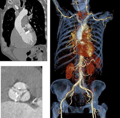 An 81-year-old woman was scanned for TAVI planning using pitch 1.7 in a single-source CT system, following administration of 60 mL contrast medium at 4 mL/s. Dose length product for entire aorta 147. Images courtesy of Dr. Bernard Bischoff.