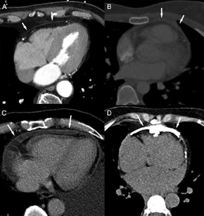 Inflammatory-effusive constrictive pericarditis in a 67-year-old man presenting with increasing complaints of dyspnea. Transthoracic and transesophageal echocardiography were inconclusive to rule out pericardial pathology. Dark-blood, T1-weighted (A), and T2-weighted short-tau inversion recovery (B) fast spin-echo cardiac MR (CMR), CMR (C), and LGE CMR (D). Loculated pericardial effusion (asterisk, A) with several fibrous layers, fluid-fluid level (arrow, B), several fibrous strands, and thickened appearance of the pericardial layers strongly enhancing the following administration of gadolinium contrast agent (arrows, D). The compression of the right ventricular free wall is well visible on CMR (C). Real-time CMR (additional movie) shows inspiratory septal inversion with an increased total respiratory septal shift confirming constrictive component. Pericardiectomy was performed showing chronically inflamed and fibrotically.