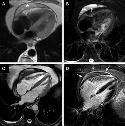 Cardiac CT of the pericardium: normal pericardium (A), thickened pericardium (B), pericardial effusion and hyperenhanced pericardial layers (C), and pericardial calcification (D). All images courtesy of the European Association of Cardiovascular Imaging of the European Society of Cardiology.