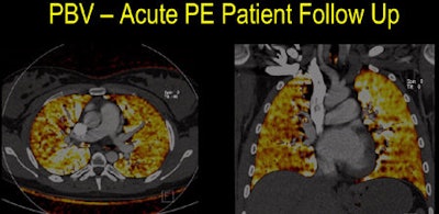 Above, patient with a large filling defect in lower left lobe had evolved at follow-up six months later, and the patient had a very good outcome. Conversely, patient below with extensive thrombus and extensive PBV defects worsened over six months, retaining extensive pulmonary emboli and defects, and developing thromboembolic pulmonary hypertension. All images courtesy of Dr. Johnny Vlahos.