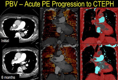Extensive thrombus