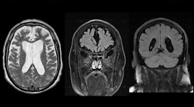 Typical example of a 73 year-old patient with fronto-temporo-lobar degeneration (FTLD). Note the apparent gradient of the atrophy from frontal to parieto-occipital, with marked widening of the sulci in the frontal lobes yet comparably minor widening of the sulci in the parieto-occipital region. Axial T2 and coronal fluid-attenuated inversion-recovery (FLAIR) in the frontal and parieto-occipital region. Image courtesy of Dr. Sven Haller.
