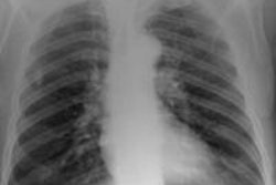 2012 02 15 18 04 45 998 2012 02 17 Chest Radiography 1a 20130821195547