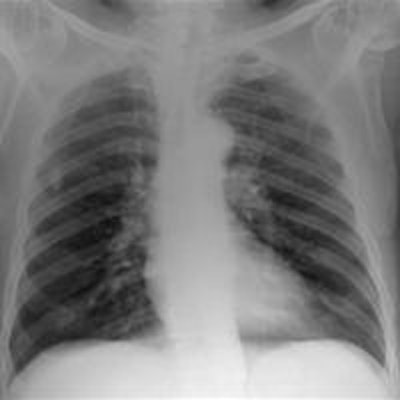 2012 02 15 18 04 45 998 2012 02 17 Chest Radiography 1a 20130821195547