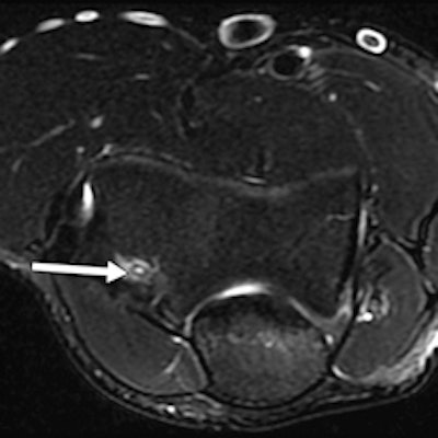 A 27-year-old male handball athlete with acute and chronic elbow pain. Coronal (left), sagittal (middle), and axial (right) proton density-weighted fat-saturated MRI examinations show osteochondral injury of capitellum (arrows). In contrast to posterior capitellar impaction resulting from acute dislocation, radial head shows no fracture or edema. Findings are in keeping with isolated chronic osteochondral injury. It is difficult to ascertain whether osteochondral injury is acute or chronic according to imaging alone.