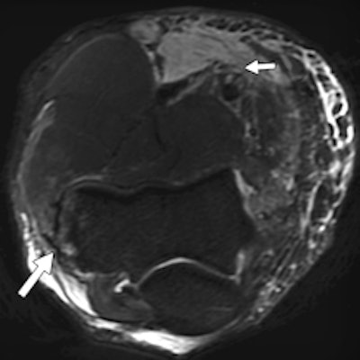 The same patient. Left: Coronal proton density-weighted fat-saturated MRI shows high-grade tear of lateral UCL (LUCL) humeral attachment (short arrow). Distal attachment of LUCL at supinator crest of ulna (arrowheads) is intact. Complete tear of UCL humeral attachment and common flexor attachment (long arrow) is seen. Right: Axial proton density-weighted fat-saturated MRI shows avulsion fracture of lateral epicondyle (long arrow). Extensive high-grade muscle tear of anterior and medial muscular compartments (short arrow) also is shown.