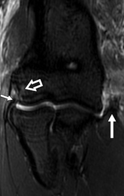 A 22-year-old female boxer who sustained direct blow to elbow during bout. Left: Radiograph of elbow shows avulsion fracture (arrow) of lateral epicondyle. Right: Coronal proton density-weighted fat-saturated MRI shows radial collateral ligament avulsion (short solid arrow). Note edema of lateral epicondyle at site of avulsion (open arrow), complete tear of proximal UCL, and superficial common flexor tendon (long solid arrow).