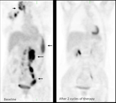 Patient with non-Hodgkin's lymphoma. Baseline PET (MIP image on left) shows involvement of nodes above and below diaphragm and spleen (arrows). After two cycles of chemotherapy, no residual abnormal uptake is visualized, indicating favorable early response to therapy.