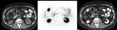 Same patient. Axial images (CT on left, PET in middle, fused PET/CT on right) show primary tumor in small bowel (above) and multiple liver metastases expressing somatostatin receptors (below).