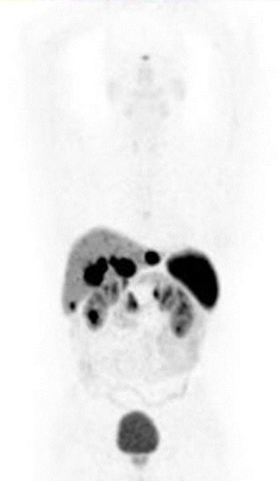 Patient with small-bowel carcinoid shows expression of somatostatin receptors in primary tumor and in liver deposits. The radiotracer Ga-68-DOTA NOC is specific for somatostatic receptors 2, 3, and 5. Maximum intensity projection (MIP) image shows focal uptake in liver and in right upper quadrant (primary tumor in small bowel). All images courtesy of Dr. Ur Metser.